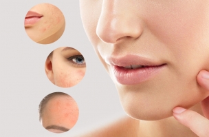 Types, Reasons, and Cures of Rosacea