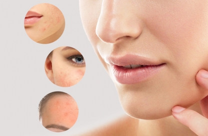 Types, Reasons, and Cures of Rosacea