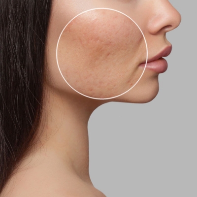 Best Acne Scar Treatment Sultanpur