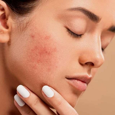 Best Acne Treatment in Delhi