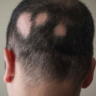 Alopecia Areata