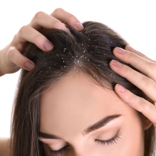 Dandruff