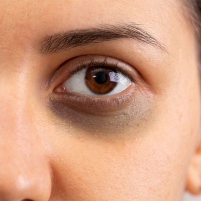 Dark Circles Treatment in Minto Road