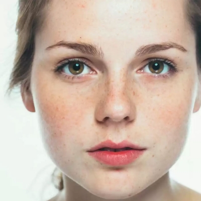 Freckles Removal Treatment in Minto Road