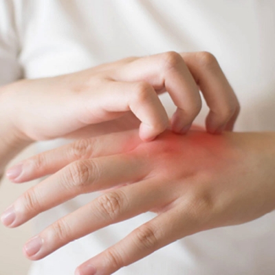 Fungal Infections Treatment Doctors in Sultanpur