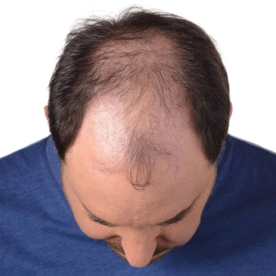 Hair Loss in Men