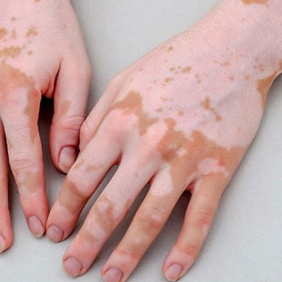 Melanocyte Cell Transfer - Treatment, Cost and Clinic in Sultanpur