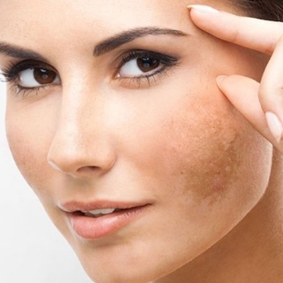 Melasma/Hyper-Pigmentation Clinic in Minto Road