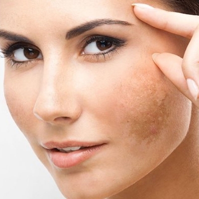 Melasma/Hyper-Pigmentation Clinic in Sultanpur