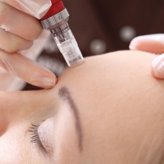 Micro Needling Therapy