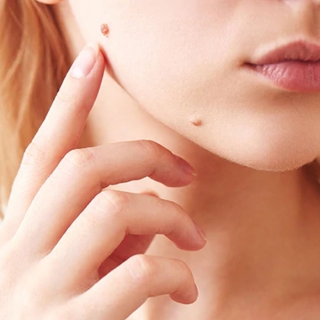 Best Mole Removal Treatment in Jharkhand