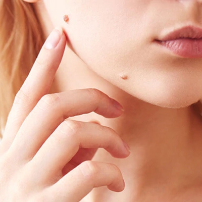 Best Mole Removal Treatment in Delhi