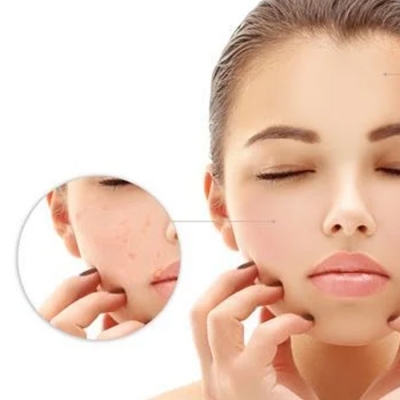 Open Pores Treatment in Delhi