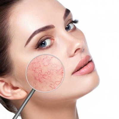 Rosacea Treatment in Delhi