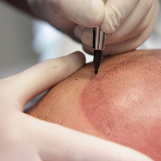 Scalp Micropigmentation Treatment in Delhi