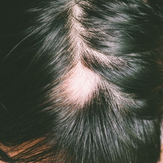 Scarring Alopecia