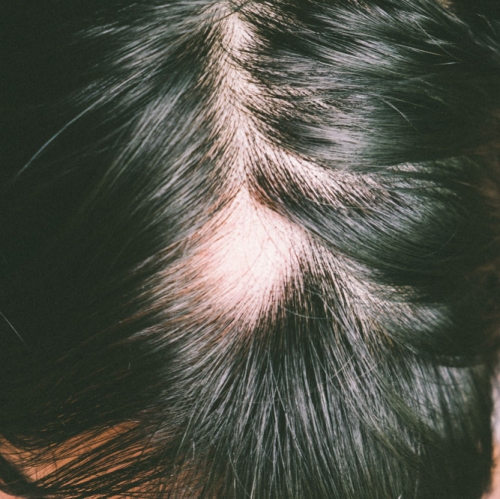 Scarring alopecia shop