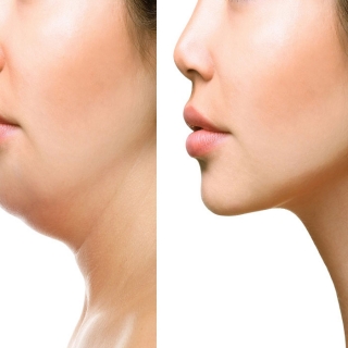 Thermage Treatment in Delhi