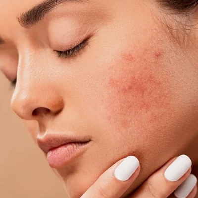 Skin Care Treatment Services in Ncr