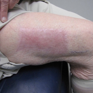 Split Thickness Skin Grafting Treatment in Chattarpur