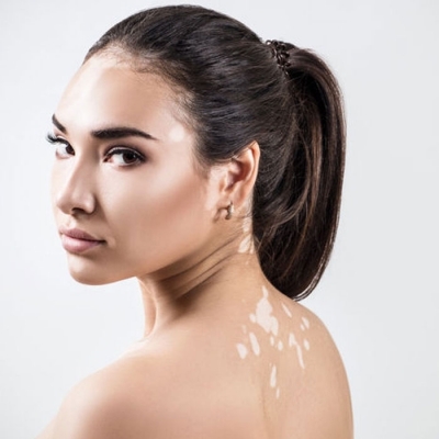 Best Vitiligo Treatment in Delhi