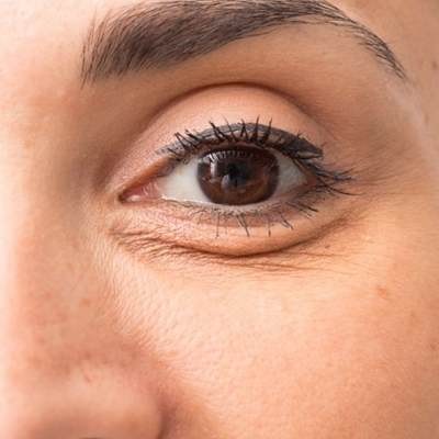 Best Laser Wrinkle Treatment in Minto Road